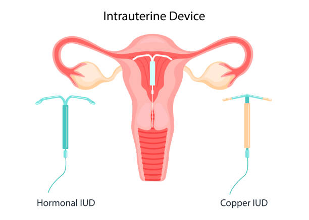 IUD-contraception. Control